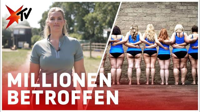 Lipödem: Wenn jeder Schritt schmerzt | stern TV